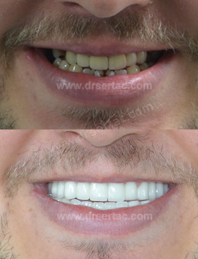 Diş estetiği beyaz diş kaplama