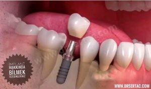 İmplant diş markaları