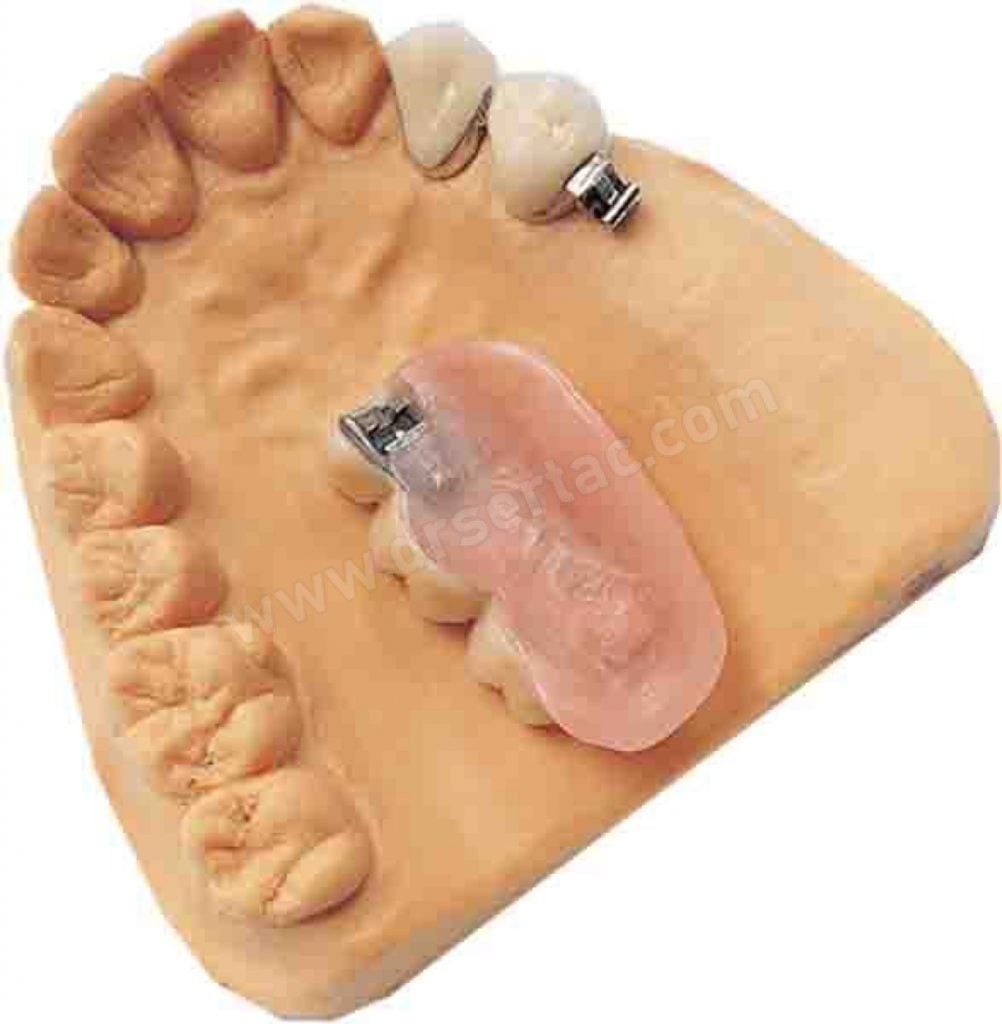 Diş protez FM gelenk